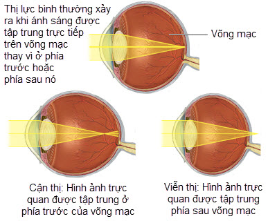 Tật khúc xạ là gì? 1