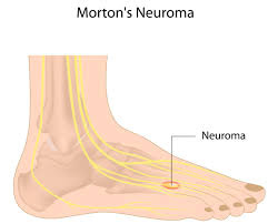 Đồ họa mô tả tình trạng của người gặp hội chứng Morton
