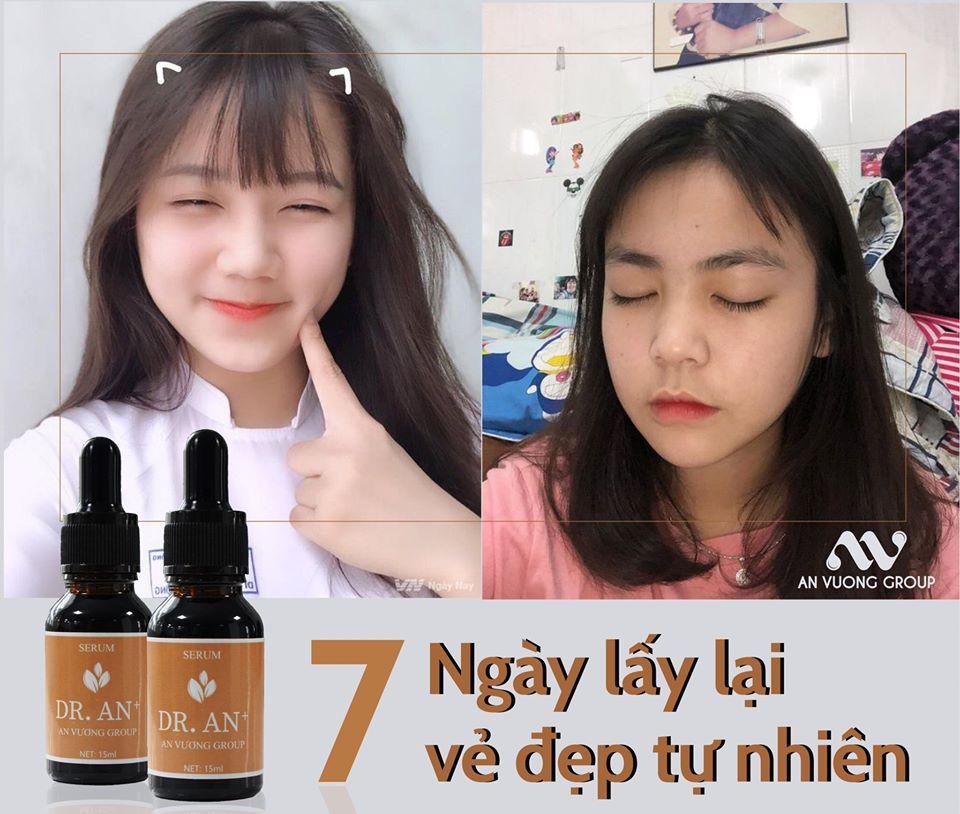 Sử dụng kem trị mụn hay miếng dán mụn