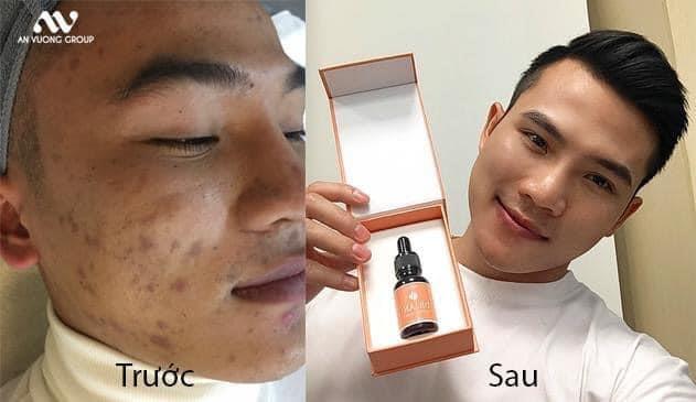 4 Bước Chăm Sóc Cơ Bản Cho Da Mụn với Serum Dr.An+