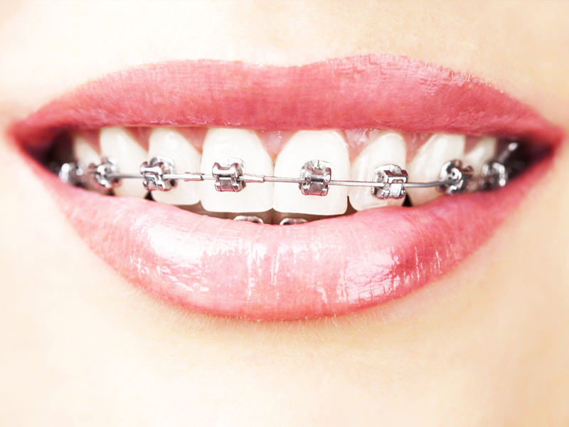 Niềng răng Invisalign