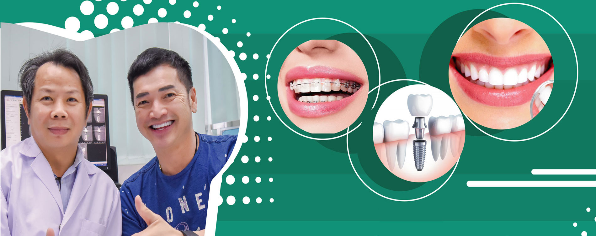 Banner chỉnh răng tại nha khoa quốc tế Bắc Việt