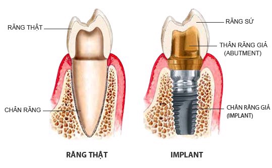 Những rủi ro có thể khi gặp cấy ghép implant