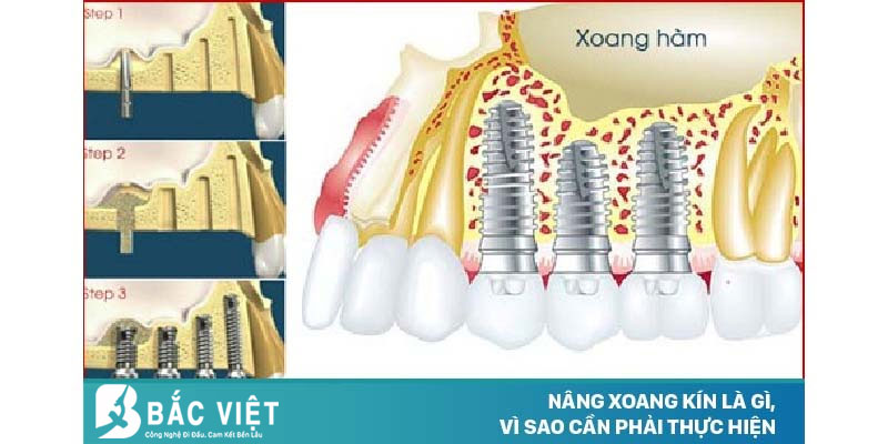 VÌ SAO CẦN PHẢI NÂNG XOANG KÍN