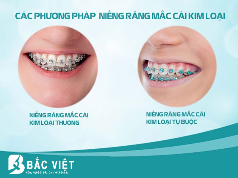 niềng răng mắc cài kim loài là gì 