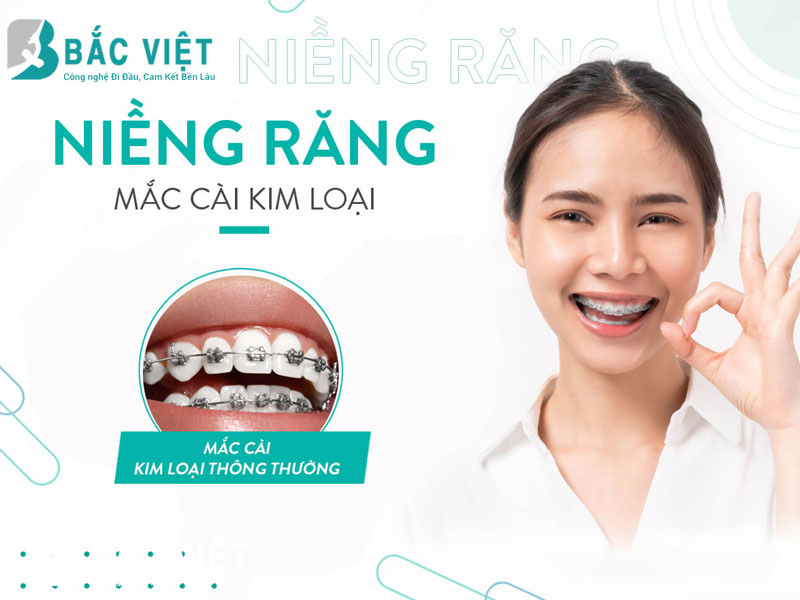 niềng răng mắc cài kim loài là gì 
