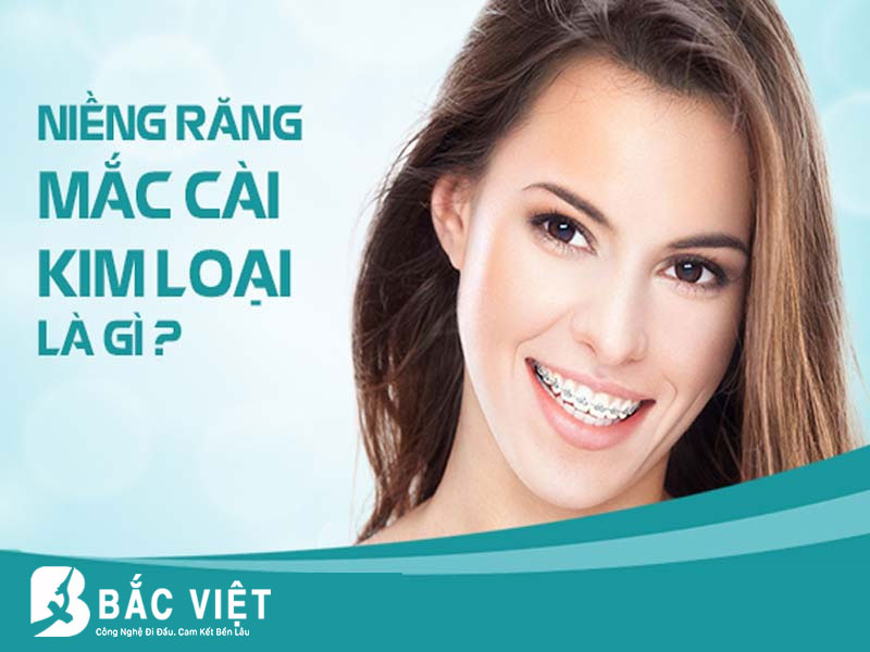 niềng răng mắc cài kim loài là gì 