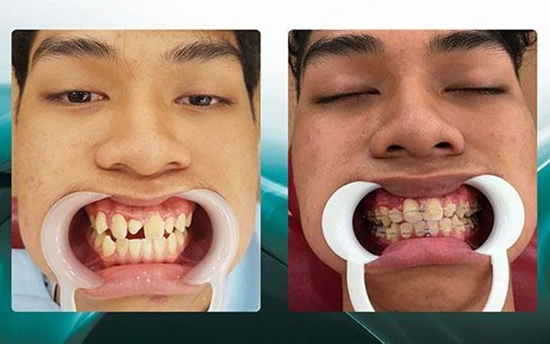 hình ảnh khách hàng niềng răng