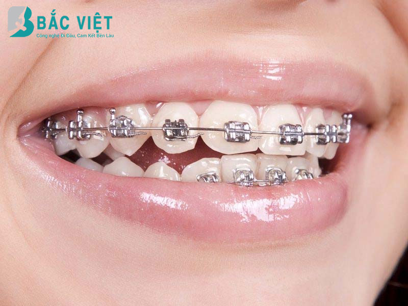 các trường hợp nên niềng răng thẩm mỹ 1