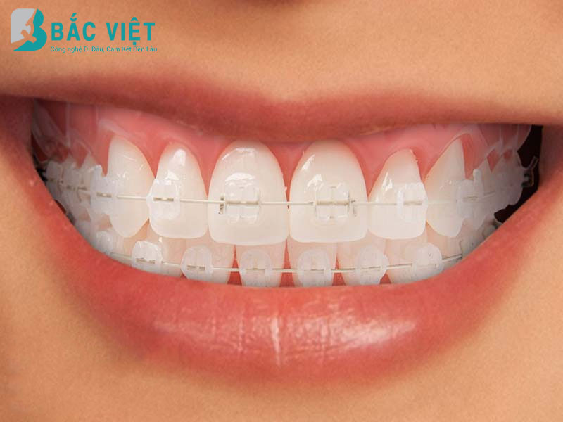  Niềng răng mắc cài sứ