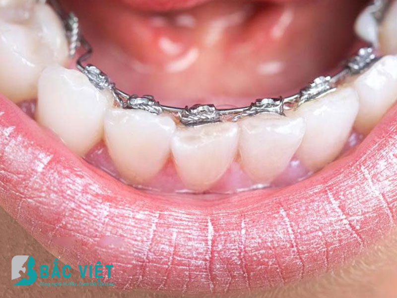 Niềng răng mắc cài mặt trong
