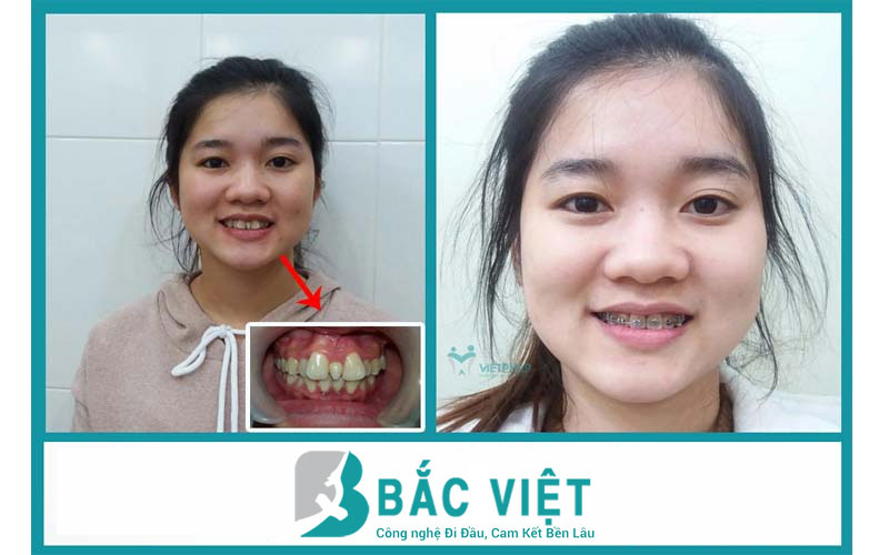 Tháo mắc niềng răng 1