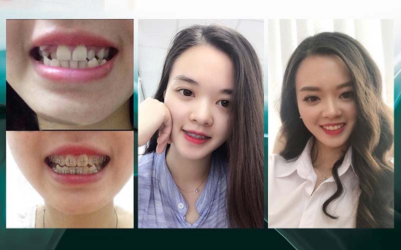 hình ảnh khách hàng niềng răng