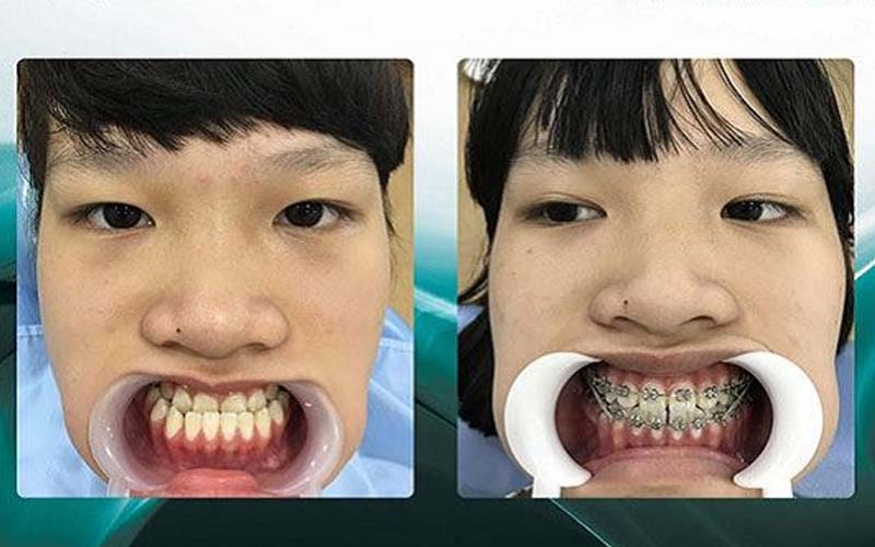 hình ảnh khách hàng niềng răng