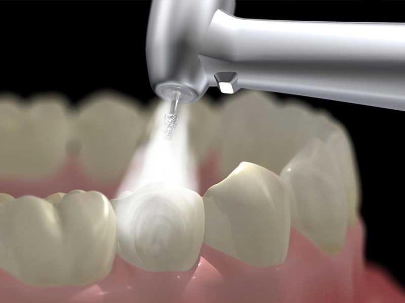 Địa chỉ lấy cao răng uy tín tại Hà Nội