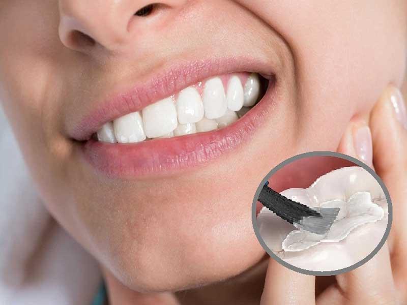 Quy trình hàn trám răng tiêu chuẩn