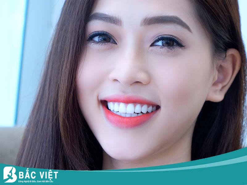 Các loại răng sứ cao cấp hiện nay